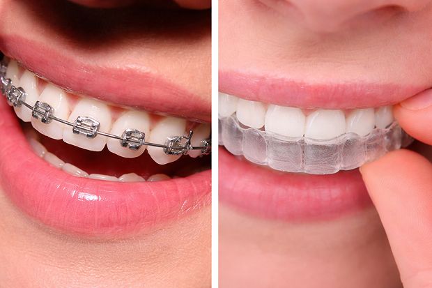Orthodontic Treatment